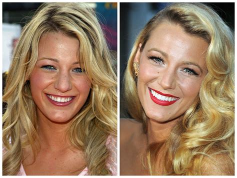 before and after celebrity teeth veneers